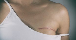 , All About Mastectomies, #Bizwhiznetwork.com Innovation &Lambda;Ｉ