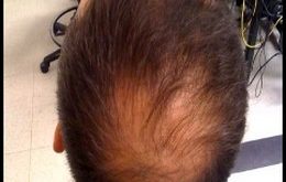 , Hair Loss Treatments In The Front and Top of Head, #Bizwhiznetwork.com Innovation &Lambda;Ｉ